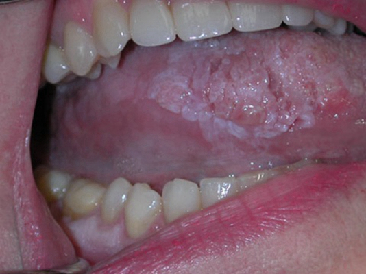 舌头癌图片