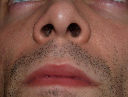 空鼻症患者图片 (45)