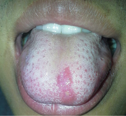 舌癌的初早期症状图片 (7)