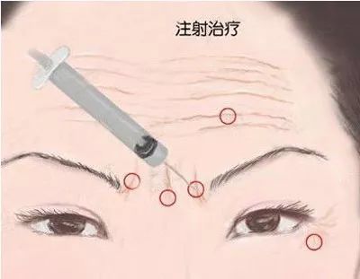 你对肉毒素误会太深了