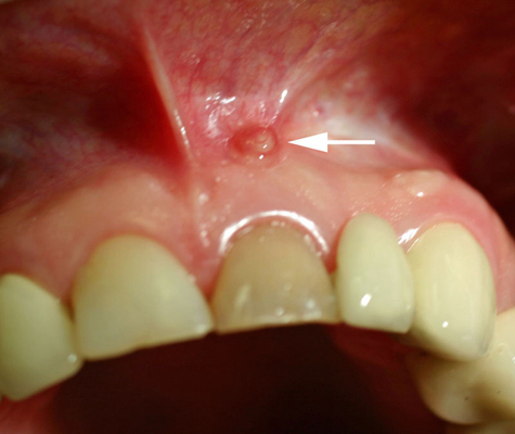 牙龈炎和牙周炎图片 (80)