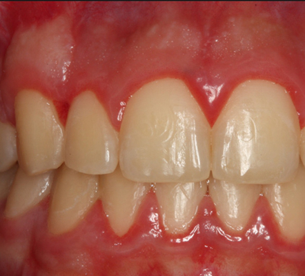 牙龈炎和牙周炎图片 (83)