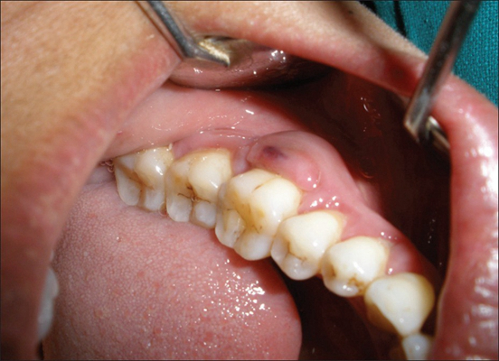 牙龈炎和牙周炎图片 (75)