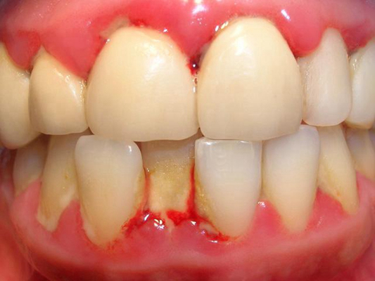 牙龈炎和牙周炎图片 (56)