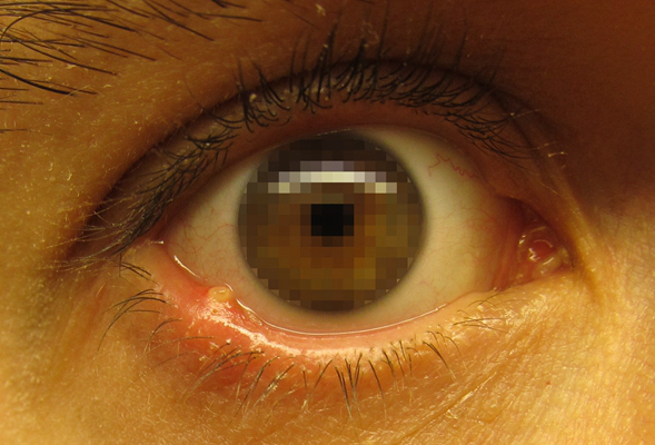 轻微沙眼的症状图片 (44)