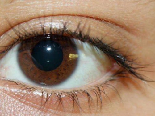 眼角膜发炎图片 (1)