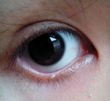 轻微沙眼的症状图片 (5)
