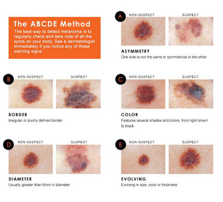 皮肤癌的早期特征图片 (10)