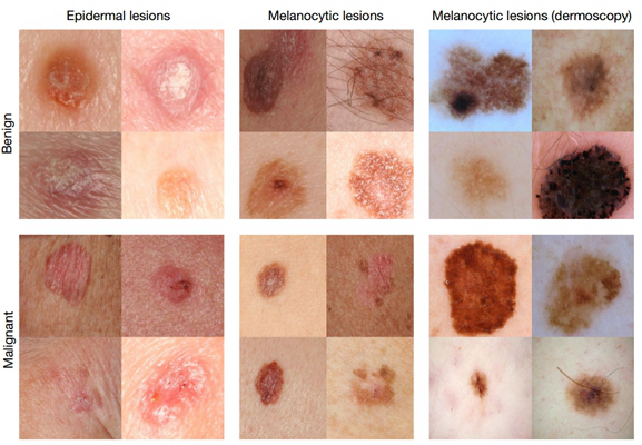 皮肤癌的早期特征图片 (24)