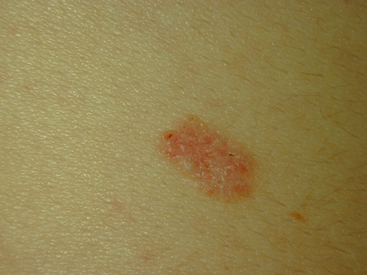 皮肤癌的早期特征图片 (38)