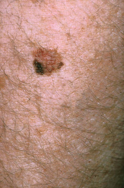 皮肤癌的早期特征图片 (43)