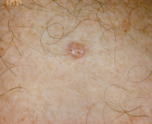 皮肤癌的早期特征图片 (35)