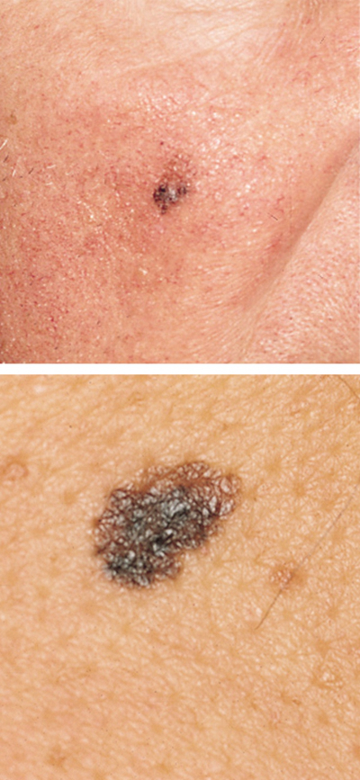 皮肤癌的早期特征图片 (46)