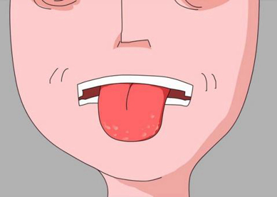 舌苔有裂纹 (3)