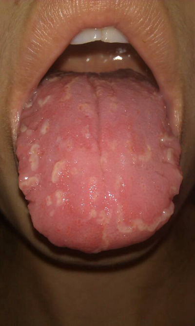 舌苔有裂纹 (40)