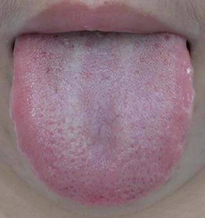 舌苔有裂纹 (46)