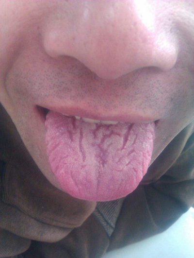 舌苔有裂纹 (43)