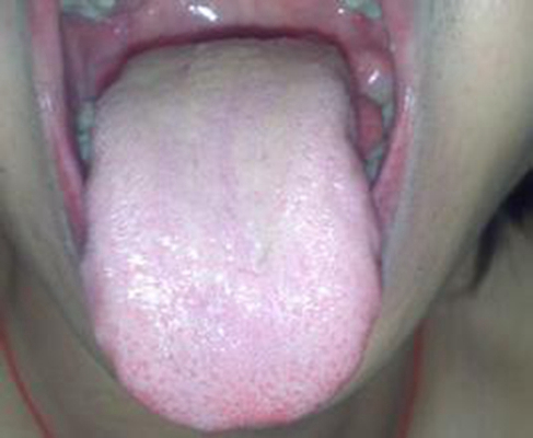 舌苔有裂纹 (10)