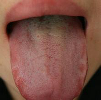 舌苔有裂纹 (13)
