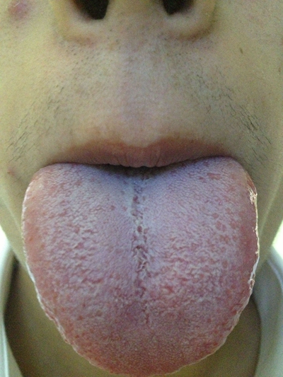 舌苔有裂纹 (24)