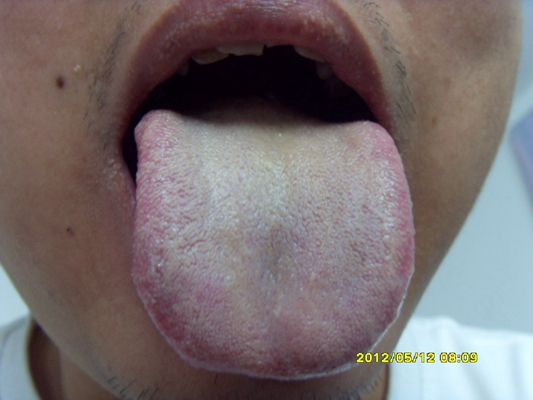 舌苔有裂纹 (27)