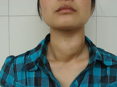 甲亢脖子症状图片 (3)