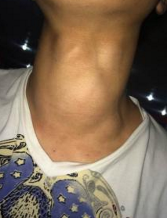 甲亢脖子症状图片 (27)