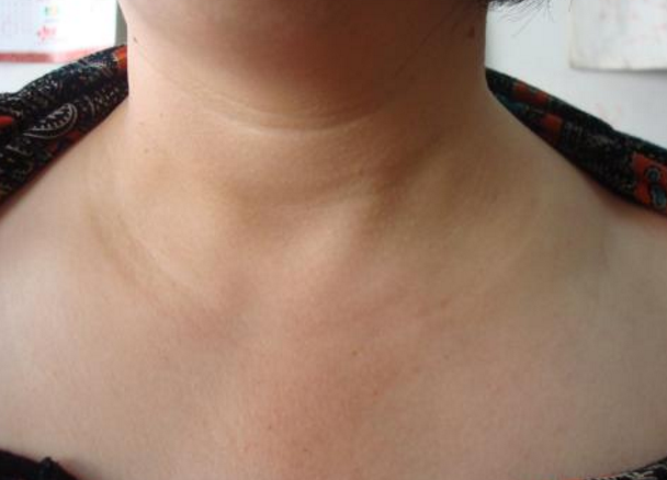 甲亢脖子症状图片 (21)
