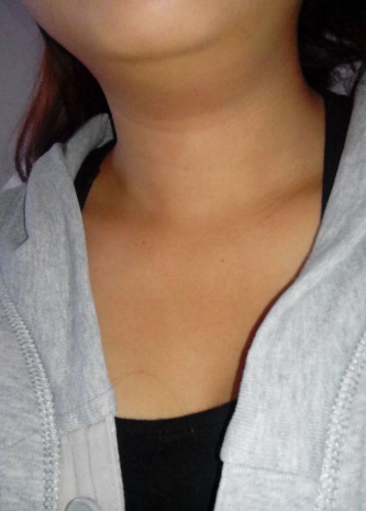 女性甲亢早期脖子图片图片