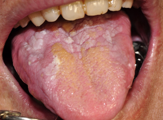 女生舌癌 初期图片