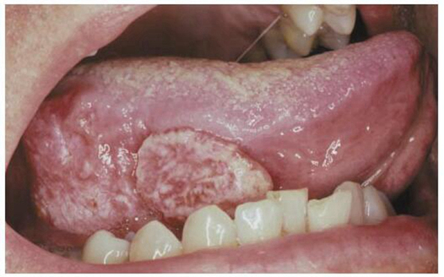 舌癌的早期症状和前兆图片