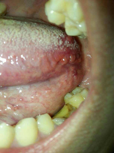 喉癌早期症状图片舌头图片