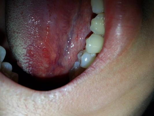 舌癌的初早期症状图片 (13)