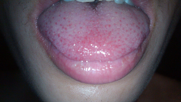 舌癌的初早期症状图片 (19)