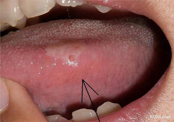 舌癌的初早期症状图片 (43)