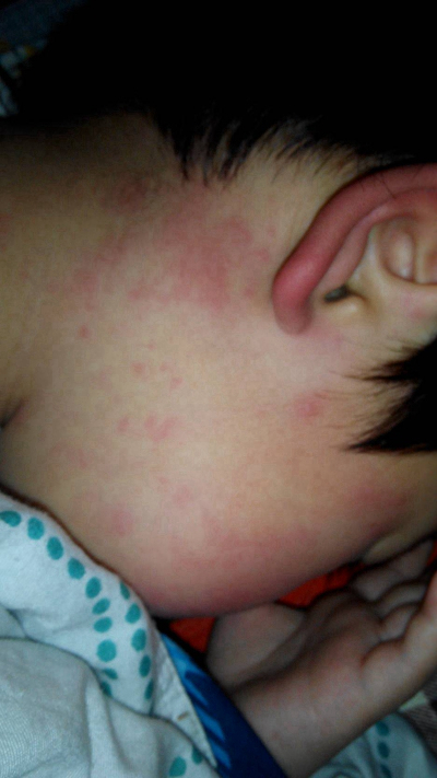 儿童过敏性皮炎症状图片