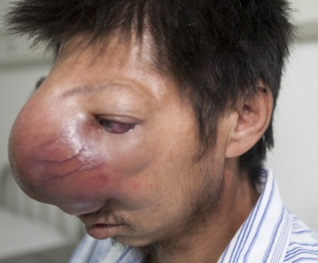 鼻癌 肿瘤图片