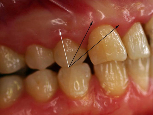 牙龈炎和牙周炎图片 (81)