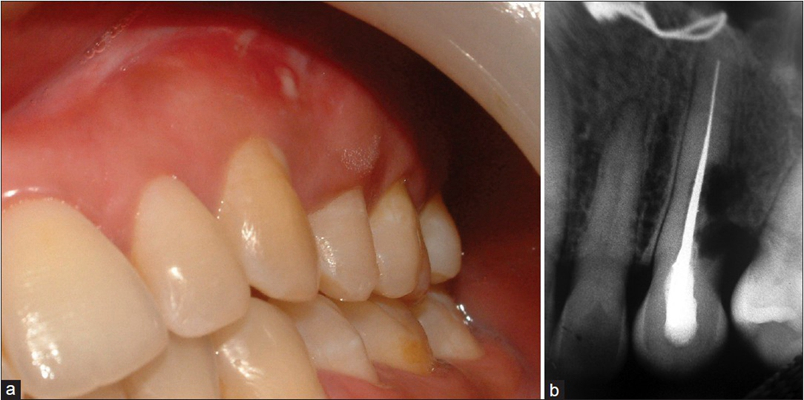 牙龈炎和牙周炎图片 (73)