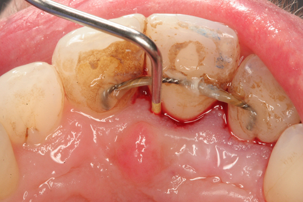 牙龈炎和牙周炎图片 (51)