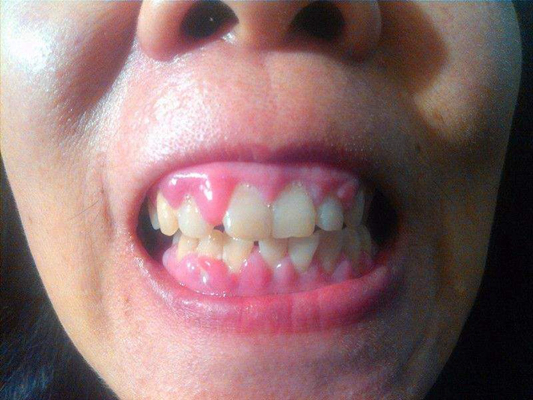 牙龈炎和牙周炎图片 (9)
