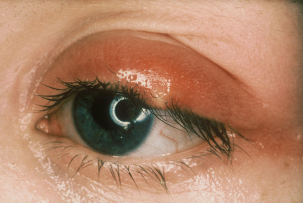 轻微沙眼的症状图片 (45)