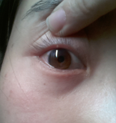 轻微沙眼的症状图片 (56)