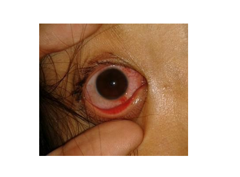 眼角膜发炎图片 (15)