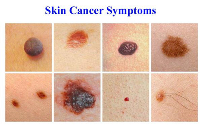 皮肤癌的早期特征图片 (28)