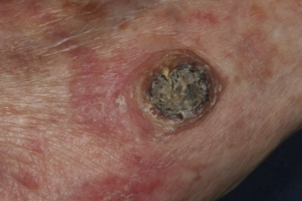 皮肤癌的早期特征图片 (25)