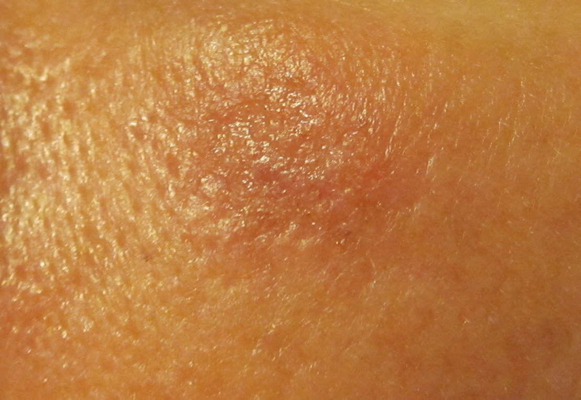 皮肤癌的早期特征图片 (22)