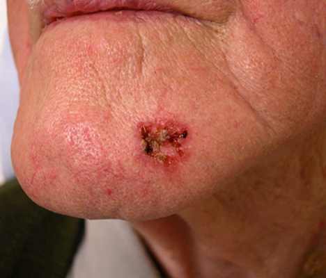 皮肤癌的早期特征图片 (44)