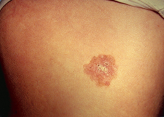 皮肤癌的早期特征图片 (36)