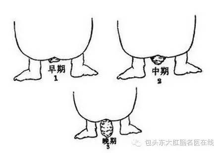 第一是懂得直肠脱垂的基本常识,第二是懂得直肠脱垂的治疗知识